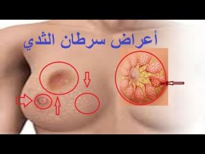 الأعراض المبكرة لسرطان الثدي