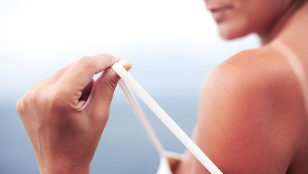 طرق سريعة لعلاج حروق الشمس