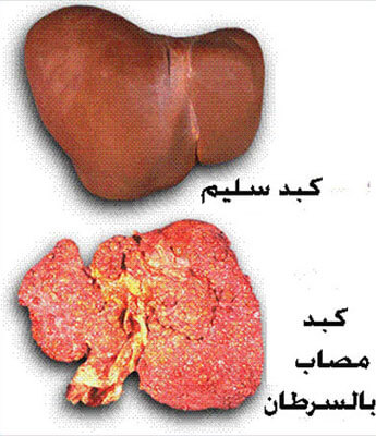 أسباب وأعراض سرطان الكبد وعلاجة