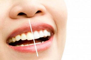 علاج اصفرار الاسنان طبيعيا بالآعشاب