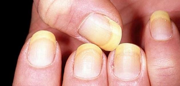 أعراض الإصابة بمرض الكبد